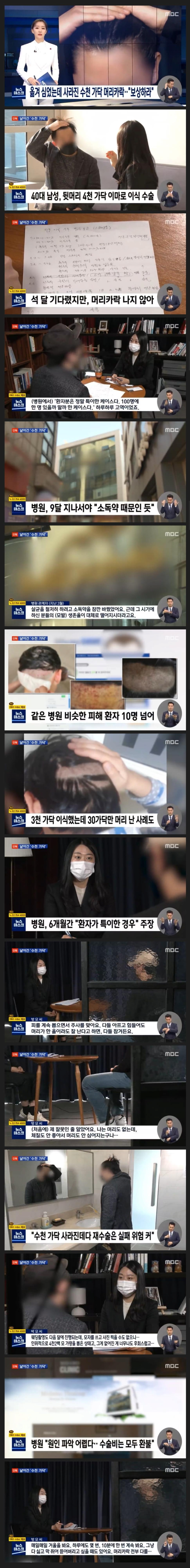 image.png 탈모주의) 모발이식 했는데 멀쩡한 4천모만 날림 .MBC