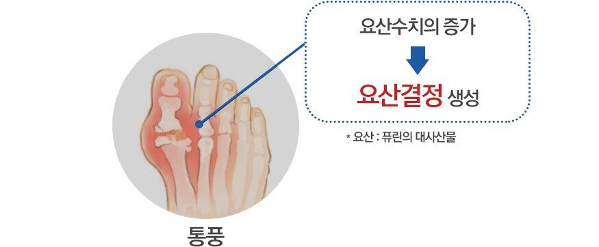 4.jpg 30대도 피해갈 수 없는 통풍