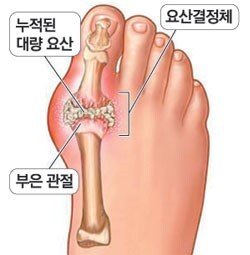 2.jpg 30대도 피해갈 수 없는 통풍